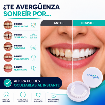CARILLAS DENTALES SNAP-ON™